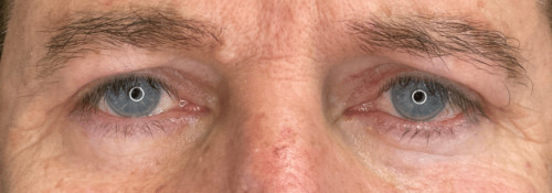 Bilateral Upper Lid Blepharoplasty Parag Gandhi Md Facs